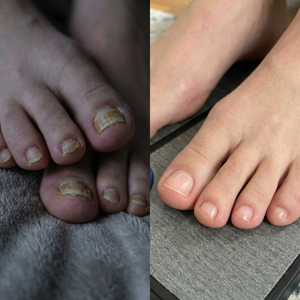 Prima e dopo: unghia col fungo vs unghia sana
