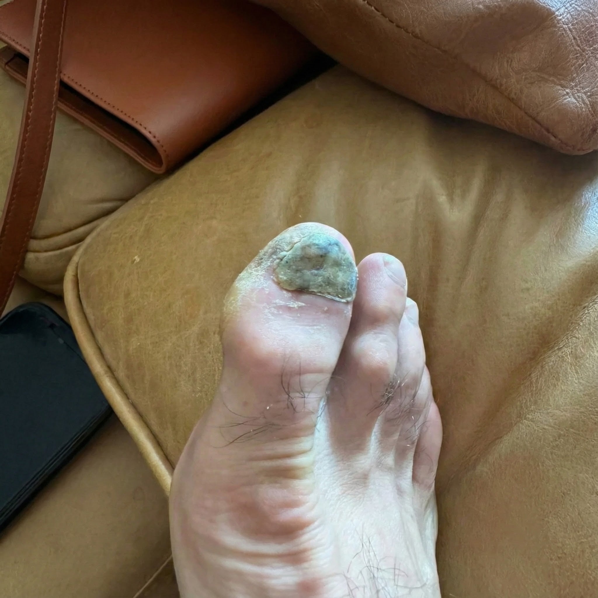 Unghia del piede ingiallita, ispessita e sgretolata dal fungo